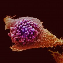 前列腺癌细胞的电子显微镜成像和人工着色