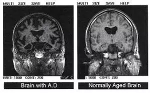 核磁共振显示患阿尔茨海默病的大脑