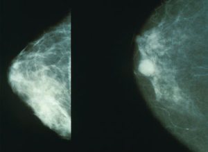 正常(左)与癌变(右)乳房x线摄影图像。