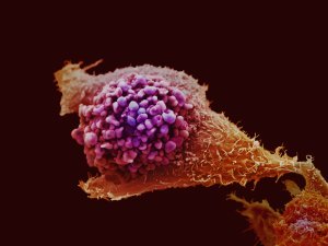 前列腺癌细胞