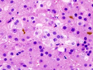 肝细胞癌的组织病理图像