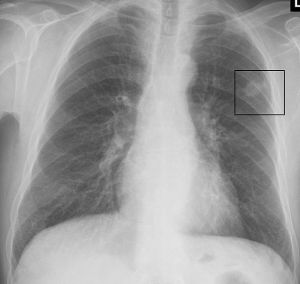 胸部x光显示左肺有肺癌