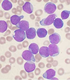 急性淋巴细胞白血病(B-ALL)