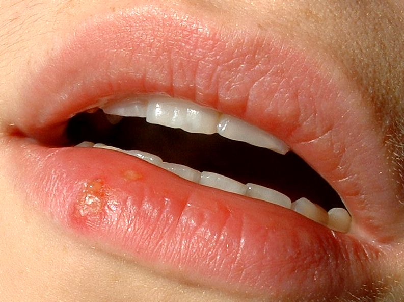 Cold sore on the lower lip (cluster of fluid-filled blisters = very infectious). These infections may appear on the lips, nose or in surrounding areas.