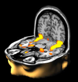 图4。当你认出一张熟悉的面孔时，在这张功能性磁共振图像(fMRI)上用橙色标出的大脑区域就会亮起来。在这种情况下，“亮起来”意味着血液流向最活跃的区域。功能性MRI可以显示这些区域。2003年威康信托生物医学影像奖获奖图片(图片由Mark Lythgoe和Chloe Hutton提供)。