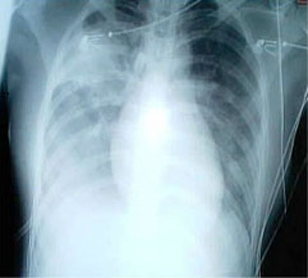 SARS X-ray appearance