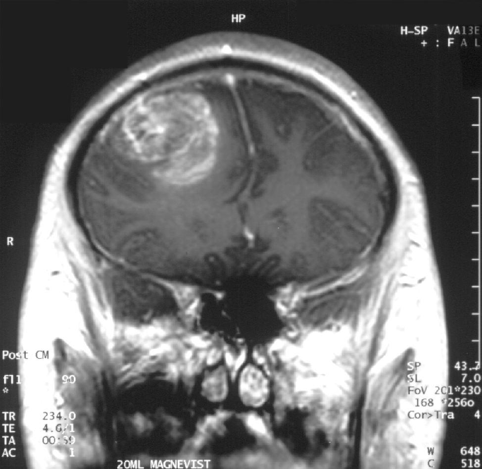 胶质母细胞瘤(星形细胞瘤):WHO分级IV级MRI冠状面，造影后。15岁的男孩。