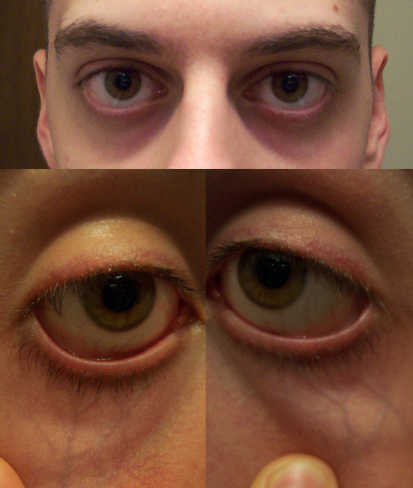 These photographs (all taken at the same time, of the same 19 year old, caucasian male) serve as examples of periorbital darkness, periorbital puffiness, pronounced vein visibility, and shadowing due to sunken eye sockets. It should also be noted...