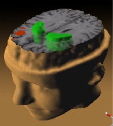 PET扫描，说明精神分裂症对大脑的影响