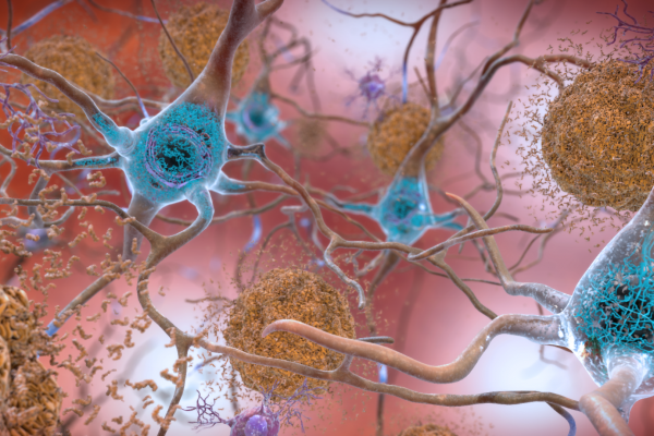 神经细胞(神经元)受阿尔茨海默病的影响，伴有-淀粉样斑块和神经原纤维缠结