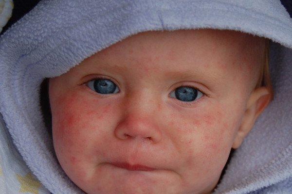 患麻疹的婴儿