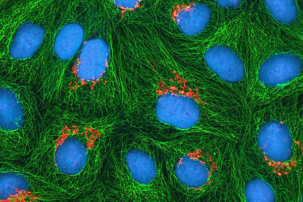 海拉细胞——最初是从癌症患者亨丽埃塔·拉克斯身上收集的——正在培养中生长。