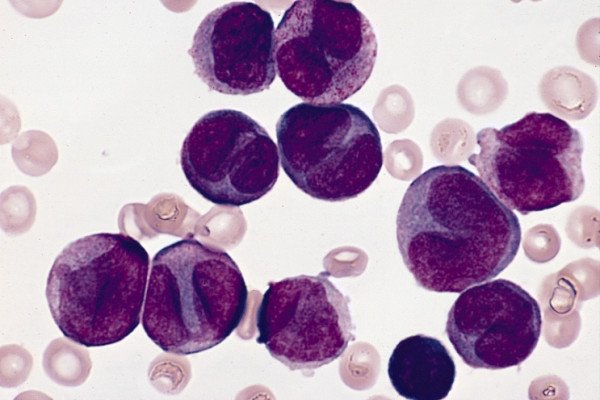 骨髓性白血病细胞