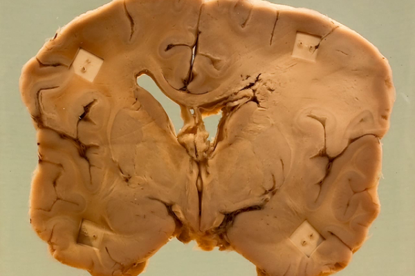 Brain abscess (fungal)