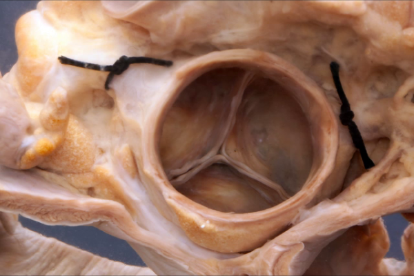 Normal aortic valve from above