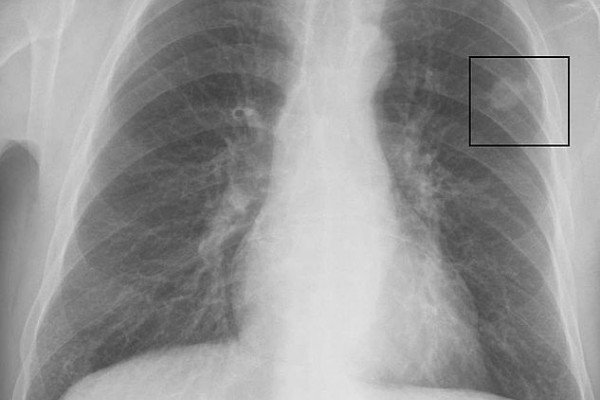 胸部x光显示左肺有肺癌。