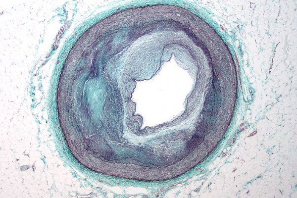 右冠状动脉远端复杂动脉粥样硬化和管腔狭窄的低倍显微镜照片。被马森三色染色。