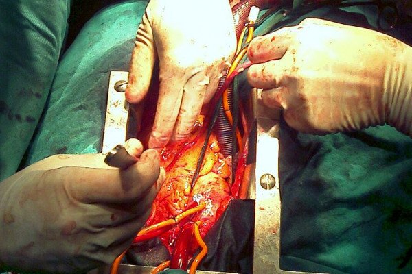 在心脏外科手术室看到的人类心脏