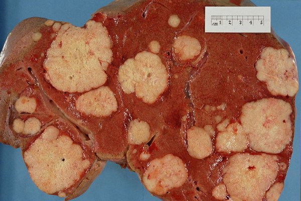人体肝脏横切面，解剖检查，显示多个大的苍白肿瘤沉积物。该肿瘤是一种源自胰腺原发病变的腺癌。