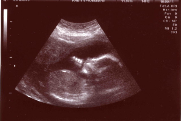 超声波检查胎儿