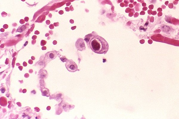 Cytomegalovirus infection: characteristic owl-eye inclusions.