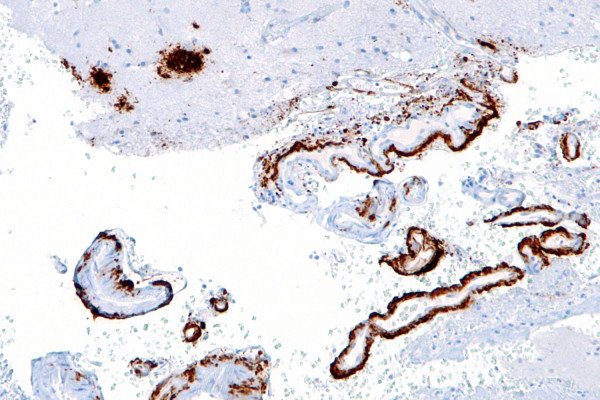 大脑淀粉样血管病的中倍镜显微照片，大脑皮层有老年斑，与淀粉样蛋白一致，见于阿尔茨海默病。淀粉样蛋白免疫染色。