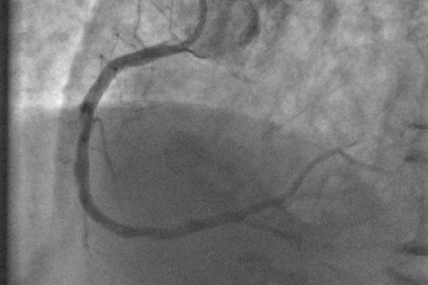 图3:打开右心脏动脉，支架放置在导管下方。