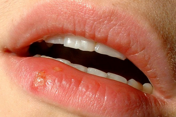 下唇唇疱疹(充满液体的水泡群=传染性很强)。这些感染可能出现在嘴唇、鼻子或周围区域。