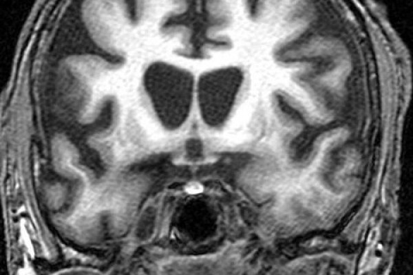 人脑尾状核水平的冠状图像显示显着的体积缩小，与患者已知的亨廷顿病诊断一致。