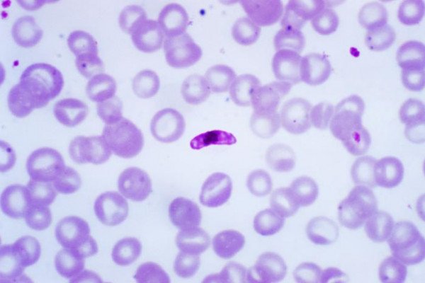 含有恶性疟原虫巨配子细胞的血液涂片的显微照片