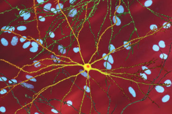 单个纹状体神经元(黄色)转染核包涵体(橙色)mHtt，背景中的其他神经元(蓝色)。