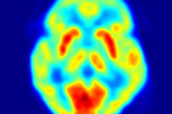 人类大脑的PET图像