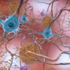 卡通的神经细胞(神经元)Alzh影响eimer's Disease with beta-amyloid plaques and neurofibrillary tangles
