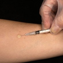 预防结核病的卡介苗疫苗