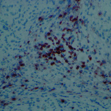 在iPSCs形成的组织中，可以看到T细胞的浸润，颜色为深棕色。