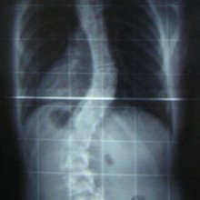 脊柱侧凸患者脊柱的x光片