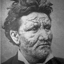 一位24岁的麻风病人，1886年摄于瑞典