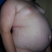 肥胖青少年(146公斤/322磅)中心性肥胖，侧视图