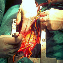 在心脏外科手术室看到的人类心脏＂title=