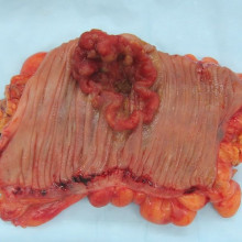 结肠内部显示一浸润性结直肠癌(火山口状，红色，形状不规则的肿瘤)。