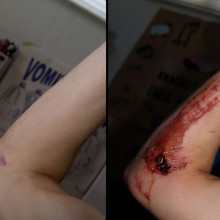 未经治疗的7天愈合的道路皮疹在一年后形成疤痕的比较图片。新鲜的伤口在右边，疤痕在左边。