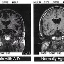 两个跨轴切片穿过头部。右图显示的是正常的大脑;左边的差异被解释为阿尔茨海默病的迹象