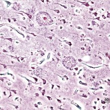 老年斑的组织病理学图像在大脑皮层的阿尔茨海默病患者的老年前发病。银浸渍。