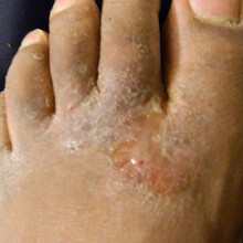 Athlete's foot fungal infection