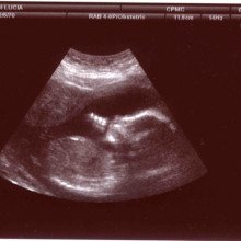 超声波检查胎儿