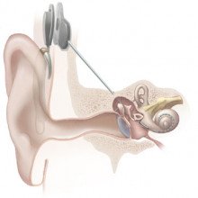 Illustration of cochlear implant from the National Institute on Deafness and Other Communication Disorders at the National Institutes of Health.