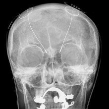 脑深部刺激-颅骨x线显示的探针(上颌和下颌骨周围的白色区域代表金属假牙，与DBS装置无关)