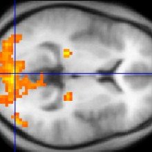 本例fMRI数据显示，在涉及复杂移动视觉刺激和休息条件的任务中，激活的区域包括初级视觉皮层(V1, BA17)，层外视觉皮层和外侧胫状体。