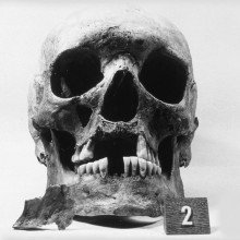 显示门牙缺失、鼻口扩大、鼻下上颚骨缺失的头骨——出土于公元12 -16世纪丹麦纳埃斯蒂维德麻风病医院墓地