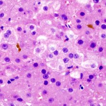 慢性丙型肝炎感染并发肝硬化患者肝细胞癌的组织病理学图像。苏木精伊红染色。